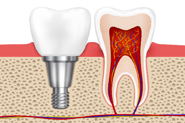 Root Canal Treatment in Redhills